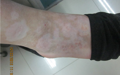 脚背上有小白点最近才发现的白点是什么