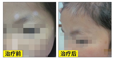 婴幼儿白癜风早期恢复过程