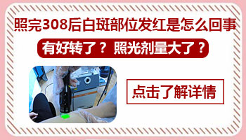 308激光治疗白癜风后白斑发红正常吗