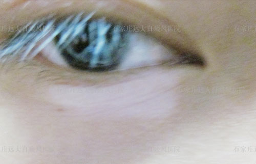 眼睛下面白斑是什么 长白斑的原因有哪些