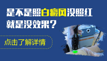 家用308照白癜风白斑不发红是不是没效果