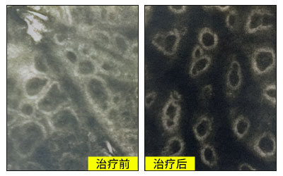 家用308照白癜风白斑不发红是不是没效果