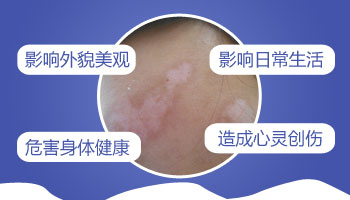 女性轻微白癜风会自愈吗 白斑对女性的影响