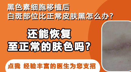 白癜风做完黑色素移植后患处发黑怎么回事