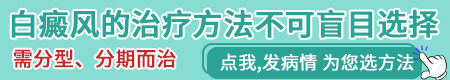 白癜风只照光跟抹药会好吗