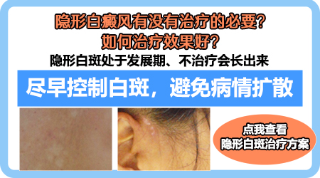 隐形白斑能控制住不显现吗