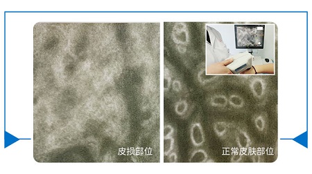 三维皮肤CT怎么确认是白癜风