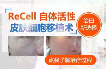 Recell自体皮肤细胞再生术 治疗白癜风怎么样