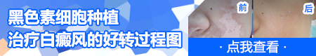 石家庄市哪家医院治白斑白点好