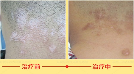 河北石家庄远大治疗白斑怎么样