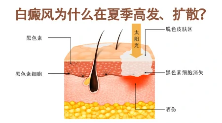 白癜风专家公益联诊-石家庄远大中医皮肤病医院