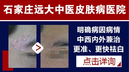 石家庄治白斑好的医院【中医治疗白斑】