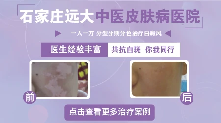 治疗白癜风网上买的仪器好用吗