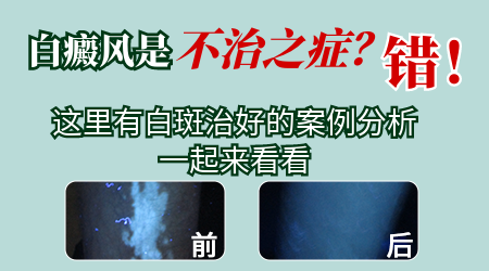 白斑好的恢复方法 能吗