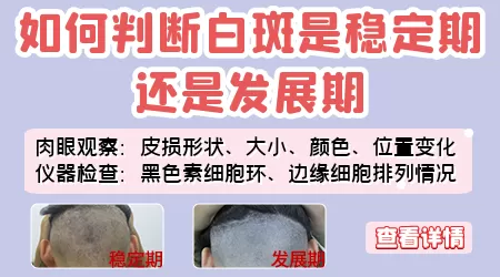 白癜风培植手术刚做完什么样