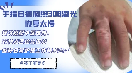 手脚白癜风为什么难治照光一直都没效果