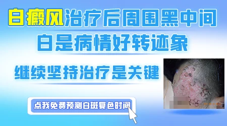 白癜风治疗后出现色素岛之后多久