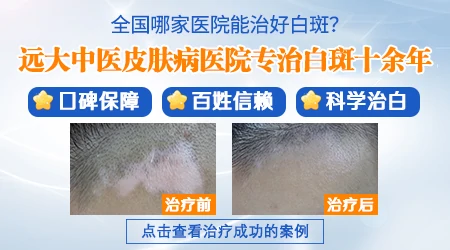 石家庄白癜风医院治疗排行榜 【治白癜风更专业】