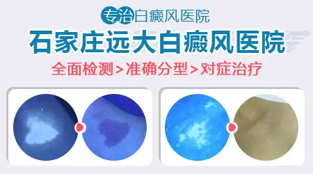 石家庄远大医院可靠吗 治白斑怎么样