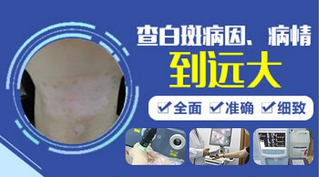 白斑伍德灯下边界模糊色差不明显