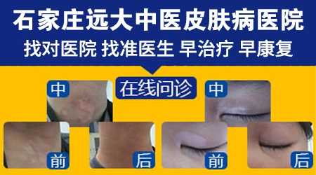 农村好的治白斑偏方