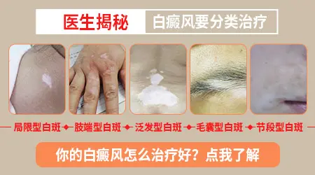 石家庄优质皮肤白斑医院 专业治白癜风的医院