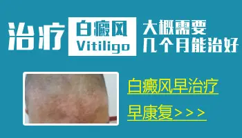 伍德灯确诊白斑准确率高吗