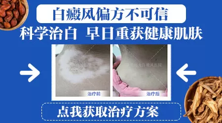 艾草擦白癜风能自愈吗