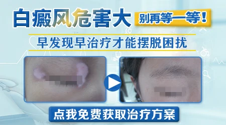 如何辨别白癜风和普通白斑 白癜风图片