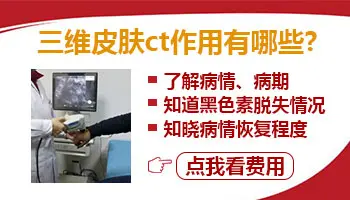 wood灯下白斑显示蓝色白色斑片