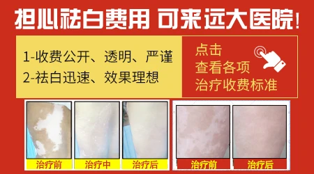 白癜风用哪些中药治疗效果好