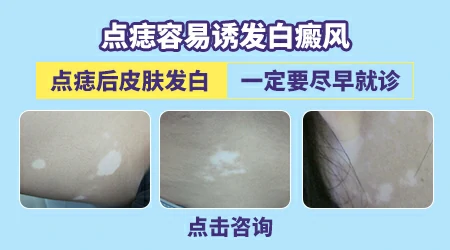 点痣为什么会发白癜风
