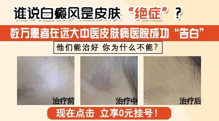 新冠过后得白癜风了能治好吗