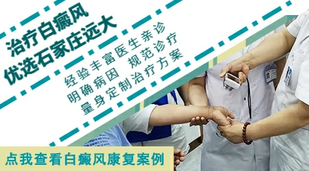 新冠肺炎引发的白癜风能治好吗