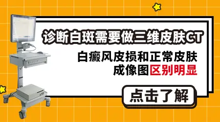 伍德灯检查白斑是不是白癜风准确率