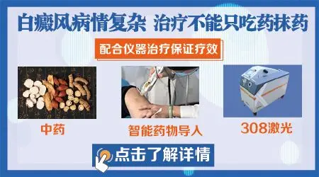 眼睛白癜风用什么药膏