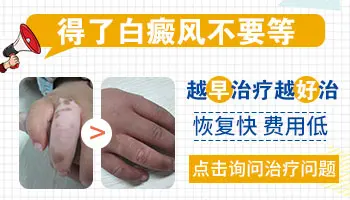 进口激光治疗白癜风费用高不高
