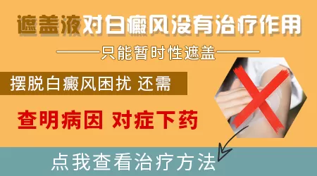 气垫能遮住白斑吗 白斑怎么样遮盖