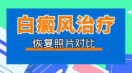 石家庄白癜风医院怎样