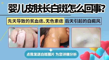 婴儿大腿一侧发白