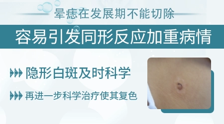 怎么确定晕痣是不是发展期白癜风