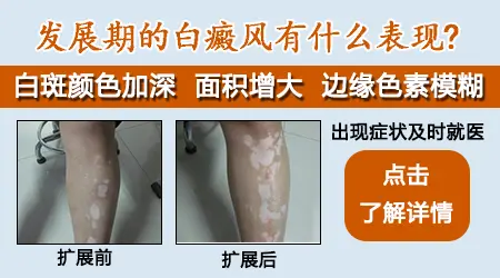 怎么确定晕痣是不是发展期白癜风