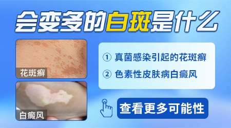 身上白斑越来越多