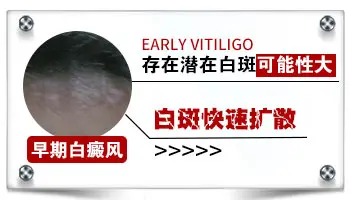 额头白斑是不是白癜风 早期白癜风症状