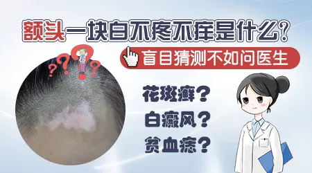 额头白斑是不是白癜风 早期白癜风症状