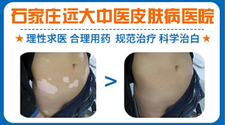 石家庄皮肤病医院 点击了解白癜风新方法