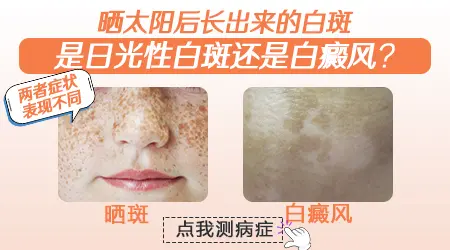 晒后出现白斑是不是白癜风