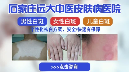 邯郸儿童白癜风医院 邯郸治儿童白斑多少钱