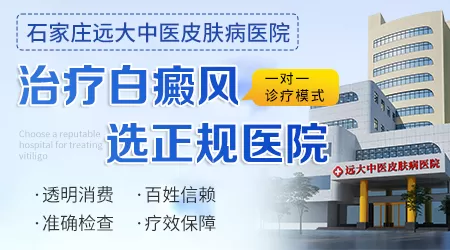 白癜风是照光后抹药吗