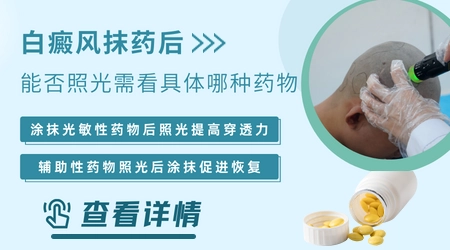 白癜风是照光后抹药吗
